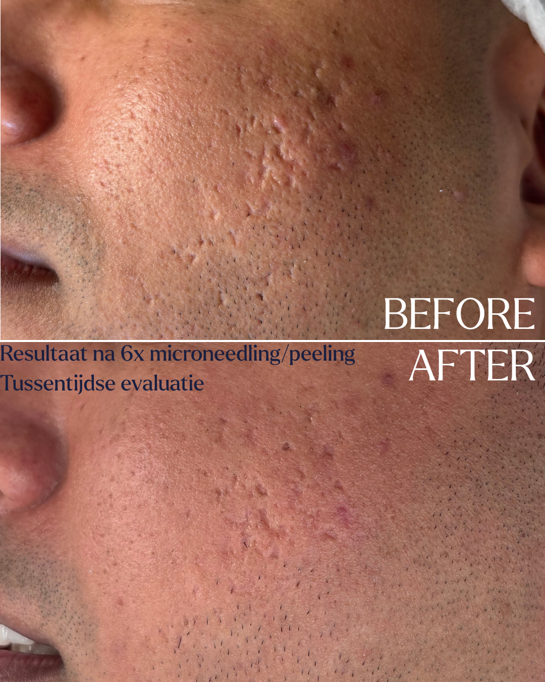 6x microneedling i.c.m. peeling. Dit is een tussenevaluatie, nog geen eindresultaat.