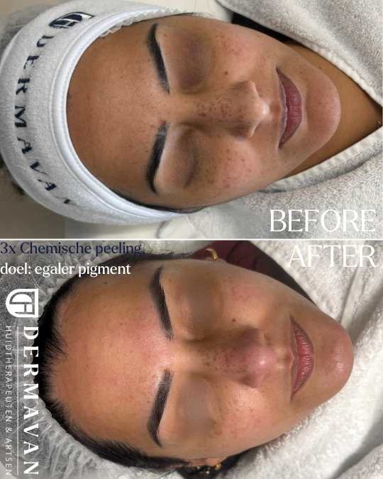 Egaler-pigmentatie-door-chemische-peeling-bij-Dermavan-Haarlem-huidtherapie-tevreden-klant-mooi-resultaat.png