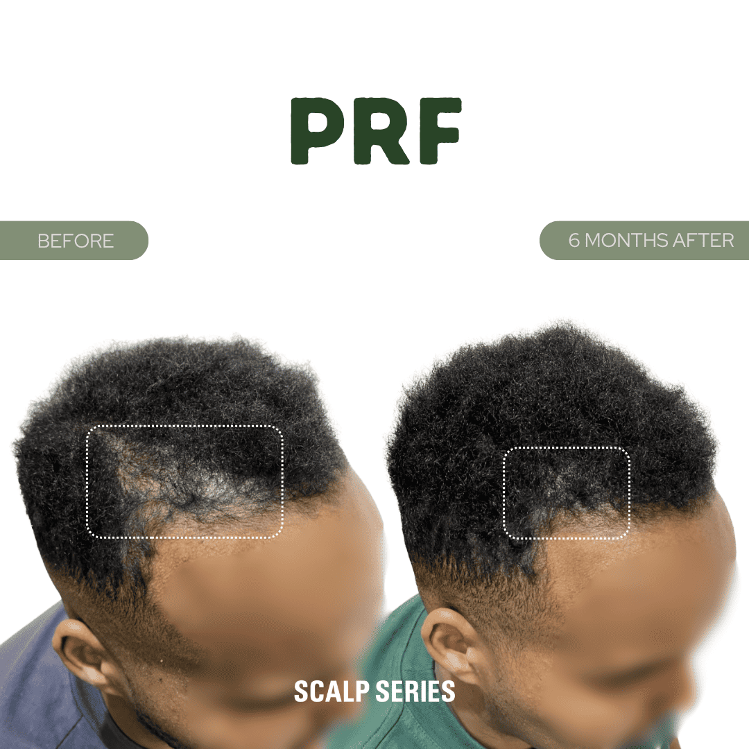 Side-by-side comparison of a man's scalp before and after 6 months of using PRF treatment, showing hair regrowth and increased density.