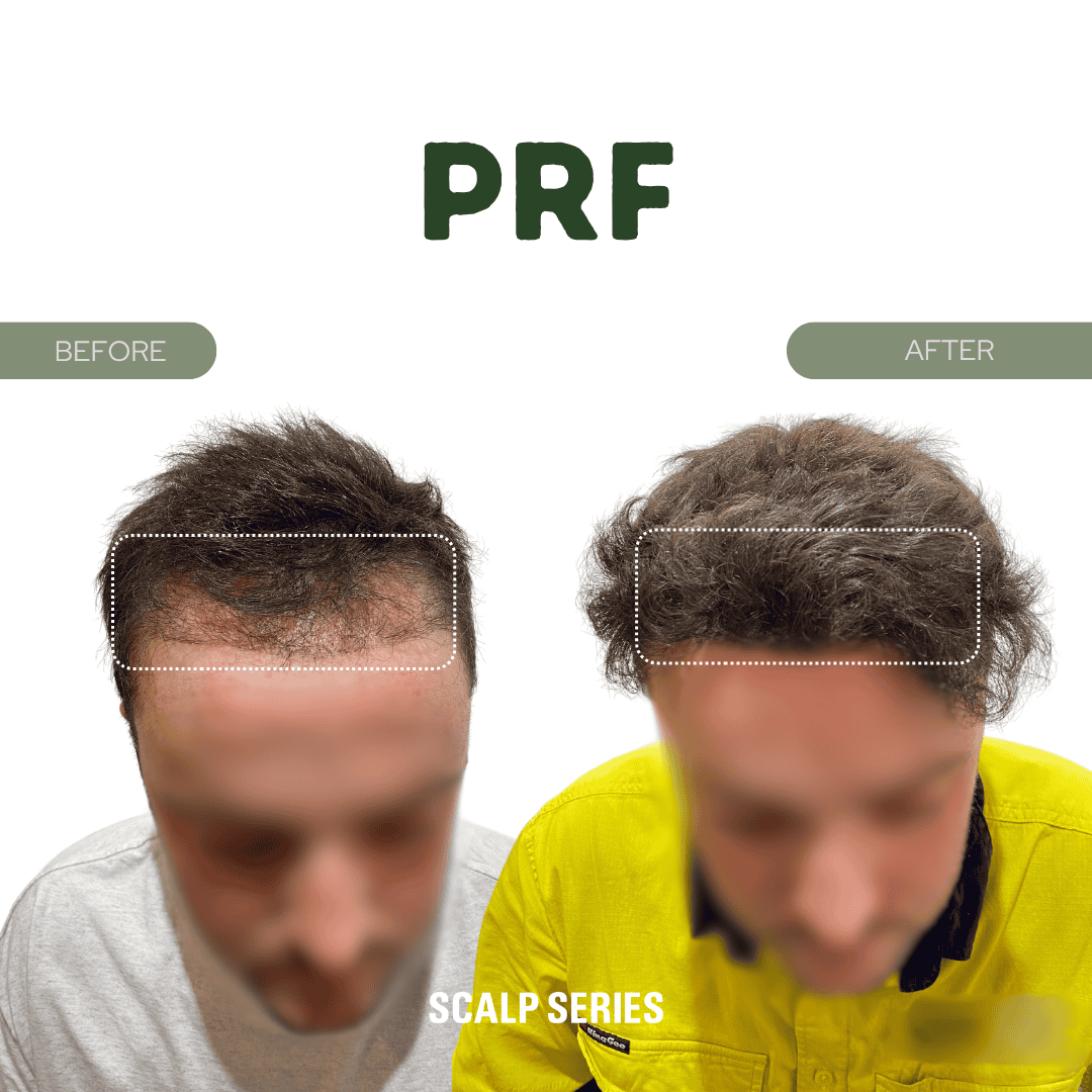 Comparison image of before and after scalp treatment showing increased hair density on the top of the head, with the label PRF and the words before and after.