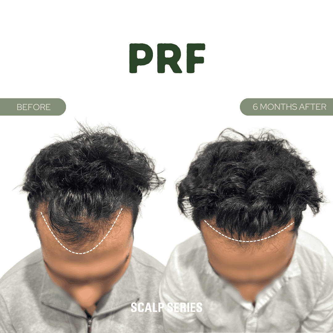 Side-by-side comparison of a man's scalp before and six months after PRF treatment, showing increased hair density and coverage.
