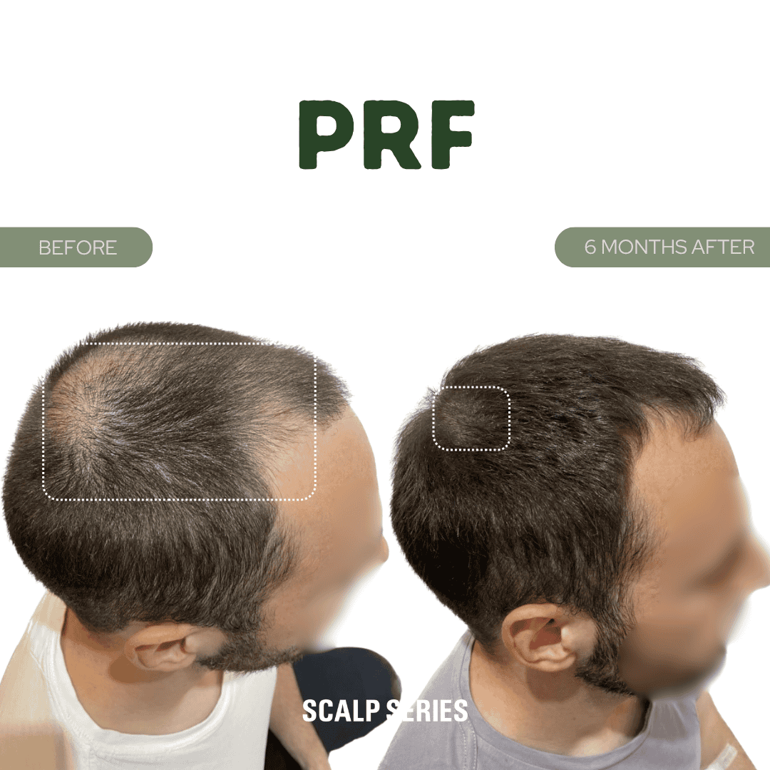 Comparison of a man's scalp before and after 6 months of PRF treatment. The before image shows significant hair thinning on the top, while the after image shows thicker, fuller hair.