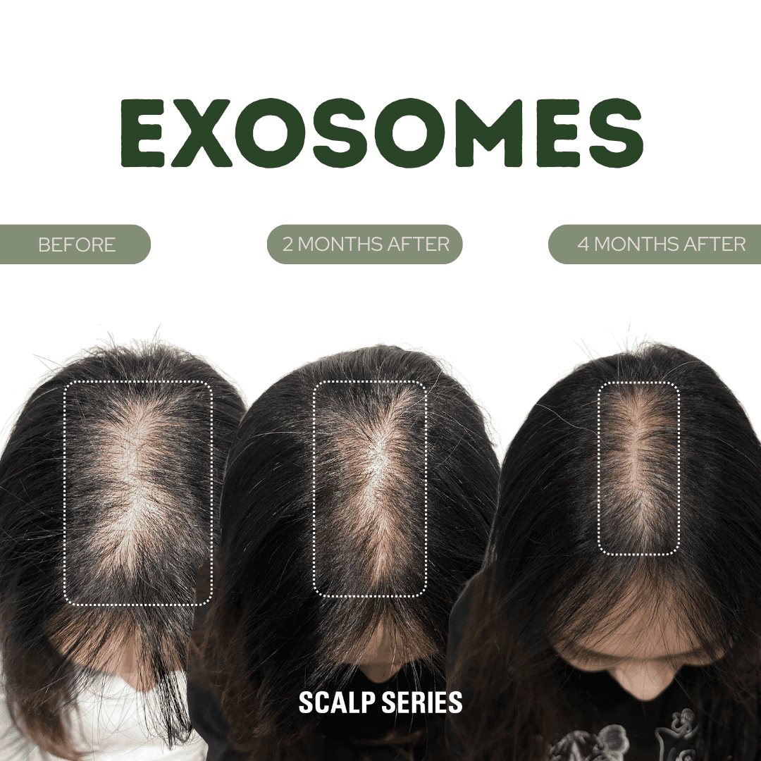 Progression of a person's scalp showing hair growth over time, labeled as before, 2 months after, and 4 months after, part of a scalp series for exosomes treatment.
