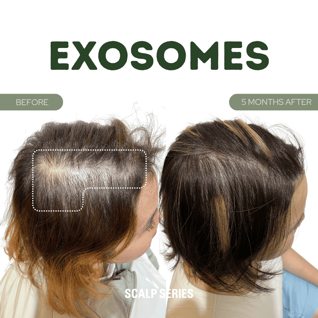 Comparison of a person's scalp before and five months after using exosomes, showing increased hair density and reduced scalp visibility.