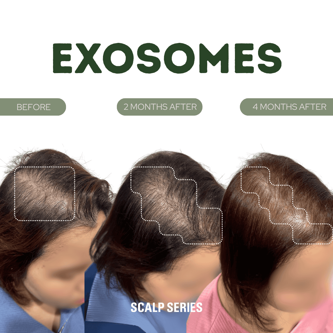 Progression of hair growth over four months through scalp serums, showing a woman with significant hair thinning before treatment, improved fullness after two months, and substantial hair regrowth after four months.