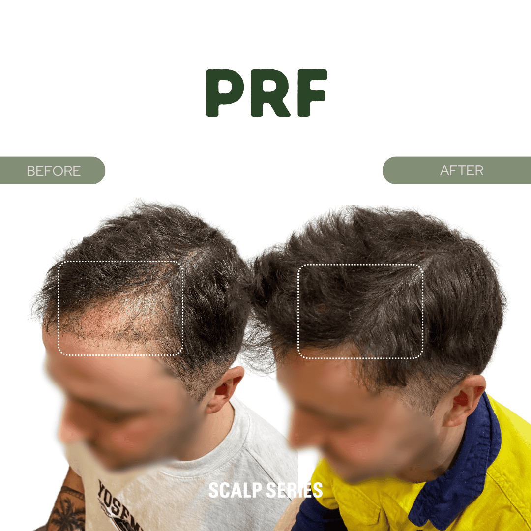 Comparison of male scalp before and after hair treatment, with the word PRF at the top, indicating scalp restoration results.