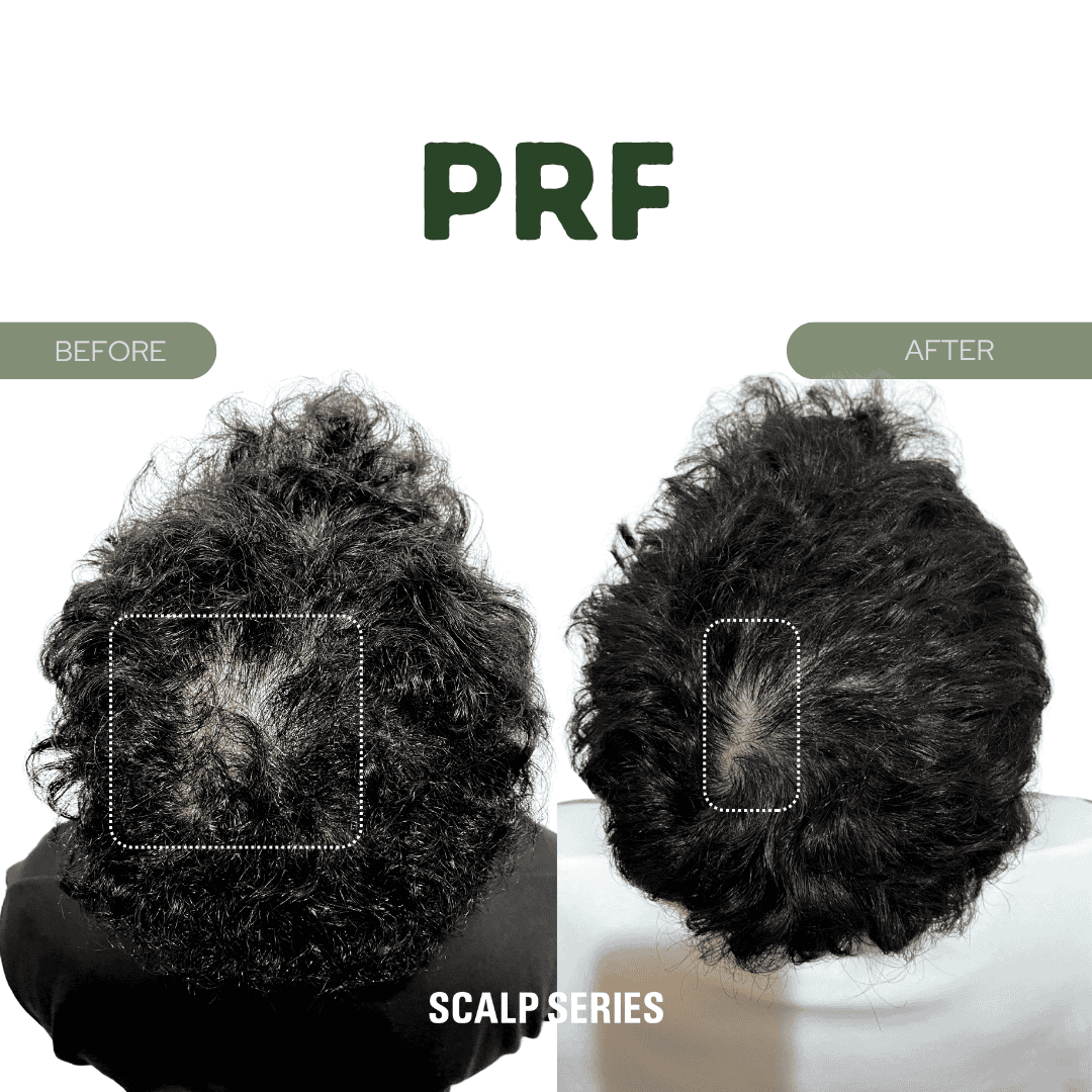 Comparison image showing the effects of PRF on scalp hair; left side labeled 'Before' showing thinning and hair loss, right side labeled 'After' showing increased hair density.