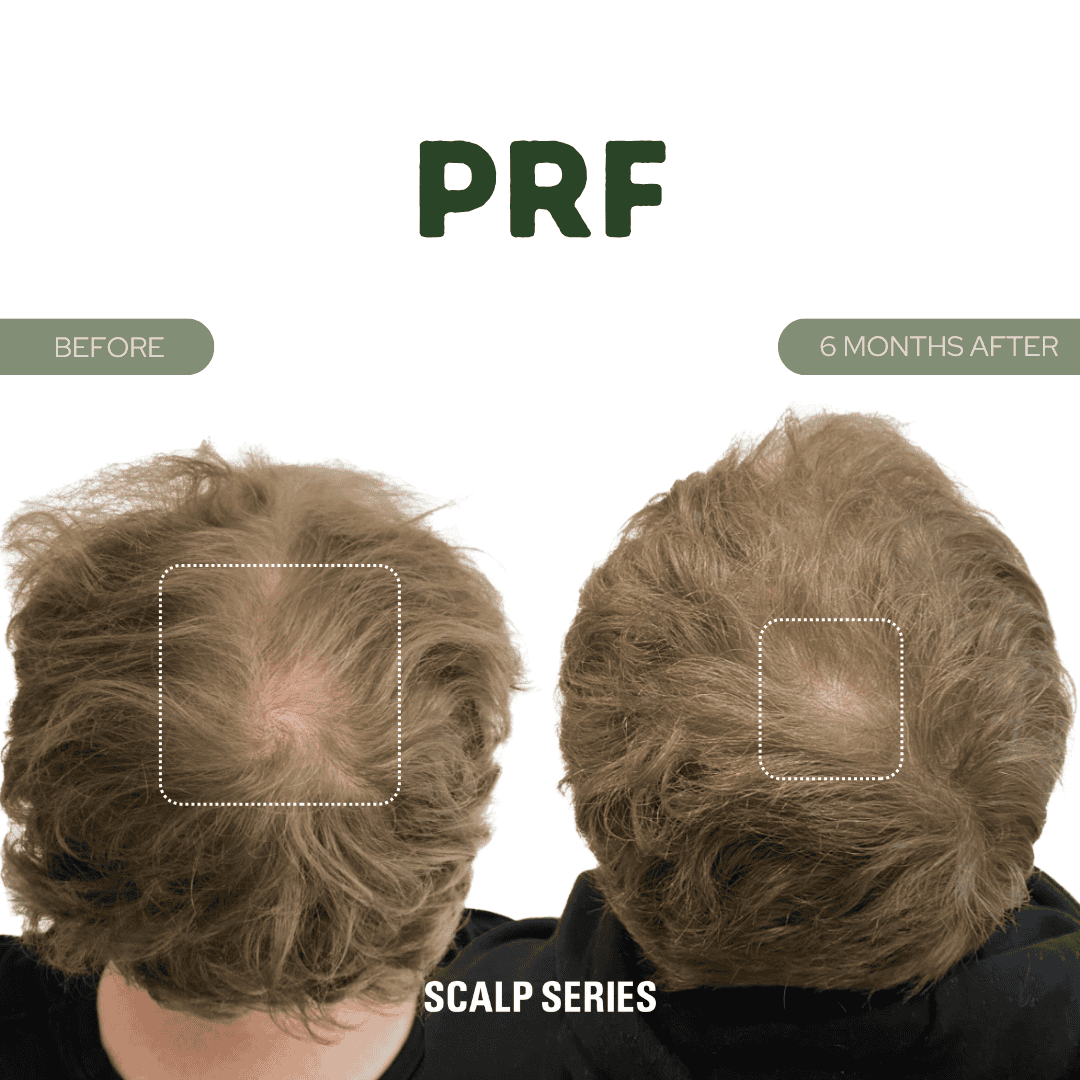 Comparison of two scalp photos for PRF treatment, showing before and after images with hair restoration results.