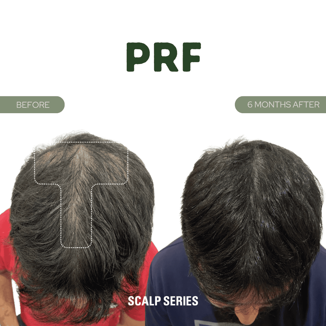 Comparison of a man's scalp before and six months after using PRF treatment, showing increased hair density and coverage.