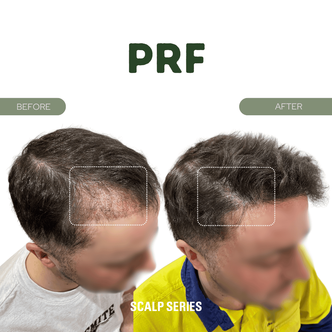 Comparison of a man's scalp before and after hair treatment, showing increased hair density in the after image, with the top label 'PRF' and text at the bottom reading 'SCALP SERIES'.