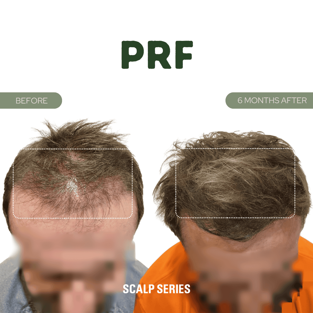 Comparison of a man's scalp before and after 6 months of PRF treatment, showing increased hair density and regrowth.