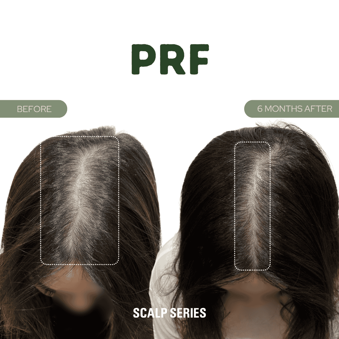 Before and after images of a woman's scalp showing hair growth over six months after using PRF treatment, with visible thicker hair and reduced scalp visibility.