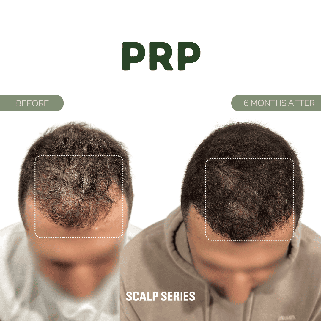 Comparison of a man's scalp before and 6 months after PRP treatment, showing increased hair density.