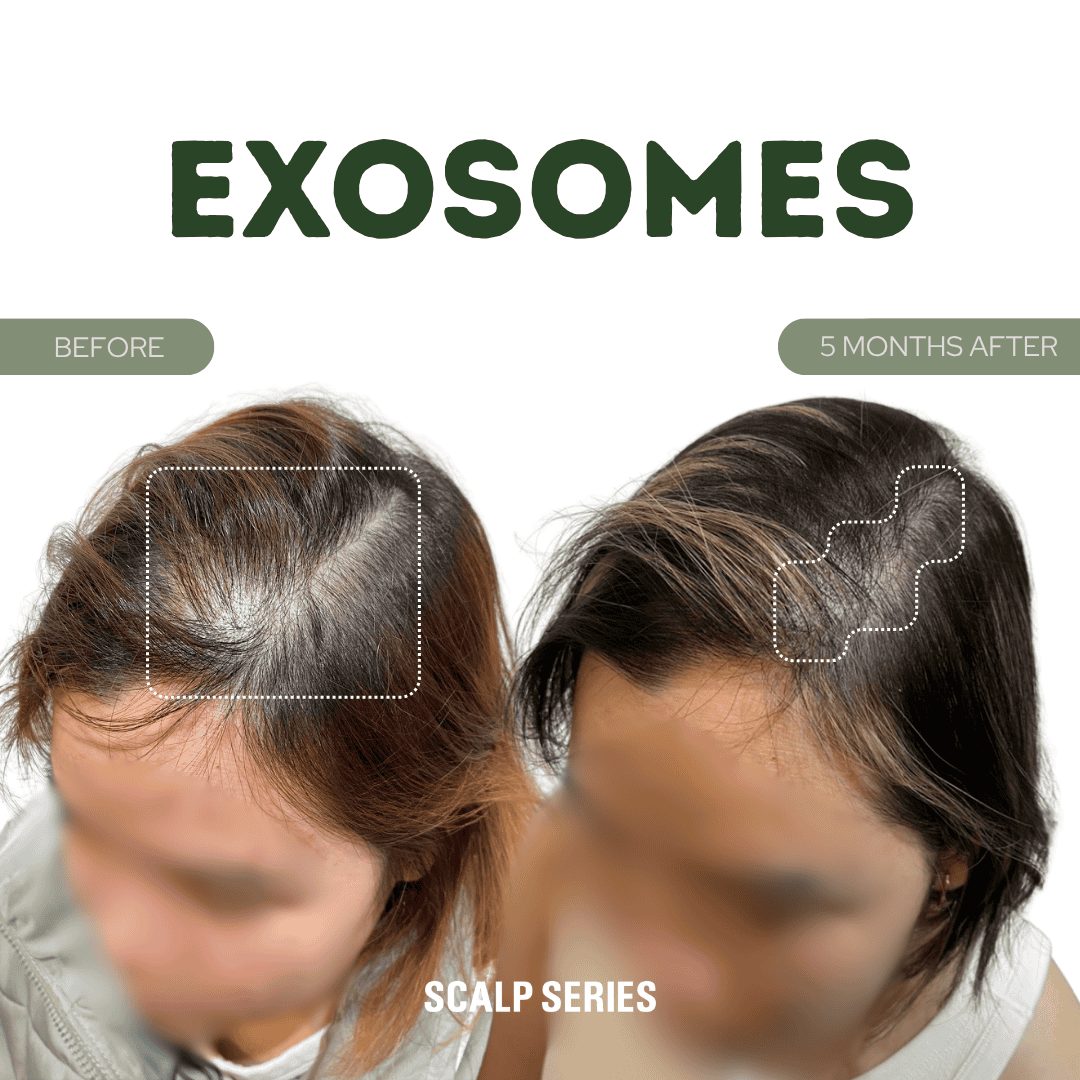 Comparison of scalp before and after five months of exosomes treatment showing hair regrowth.