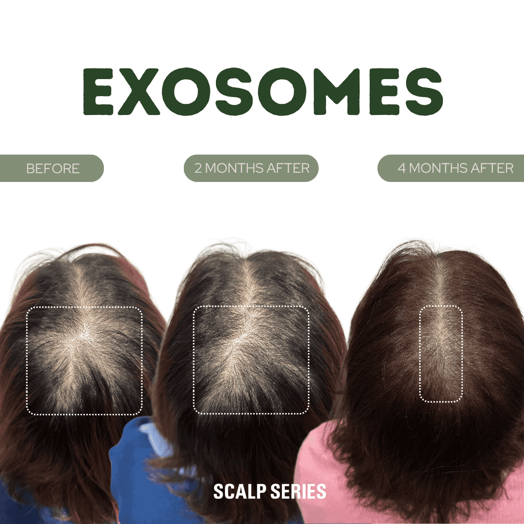 A scalp series comparison showing hair growth over time with three photos labeled 'Before', '2 Months After', and '4 Months After'.