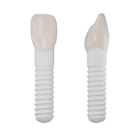 What the Research Says About Ceramic Implants: 