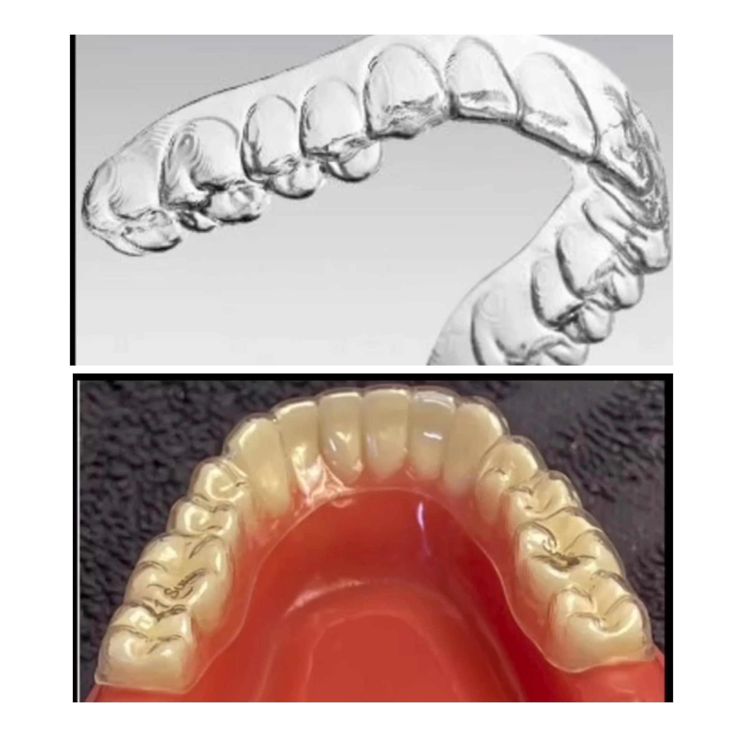 Essix Roatary File Essix Retainer After Tooth Extraction: Why It Matters and How to Care ...