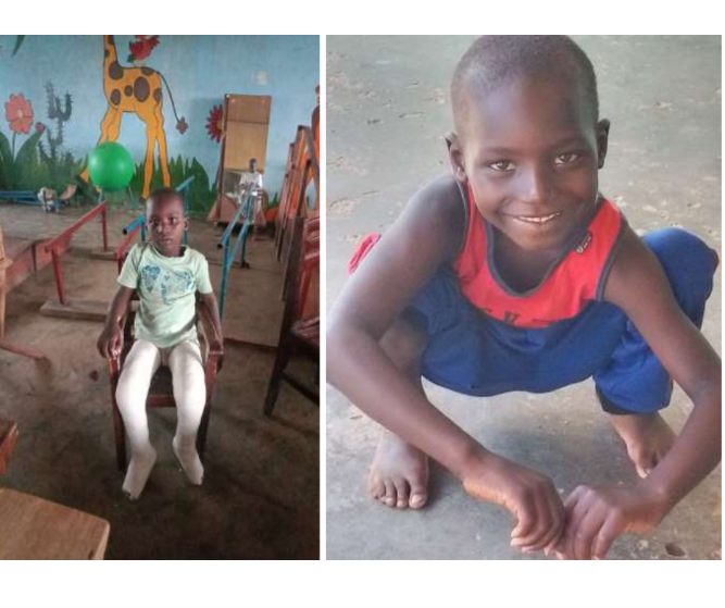 Breaking Barriers: Transforming Clubfoot Care for Older Children Around the World 