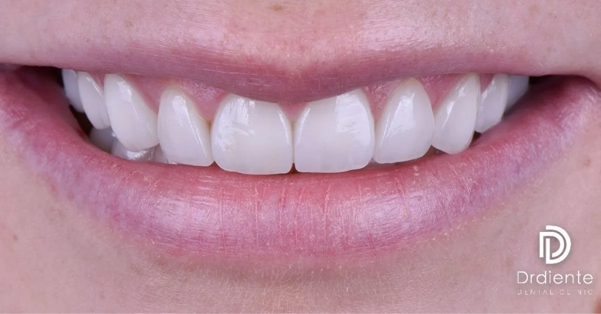 ¿Cuánto duran las carillas de porcelana?