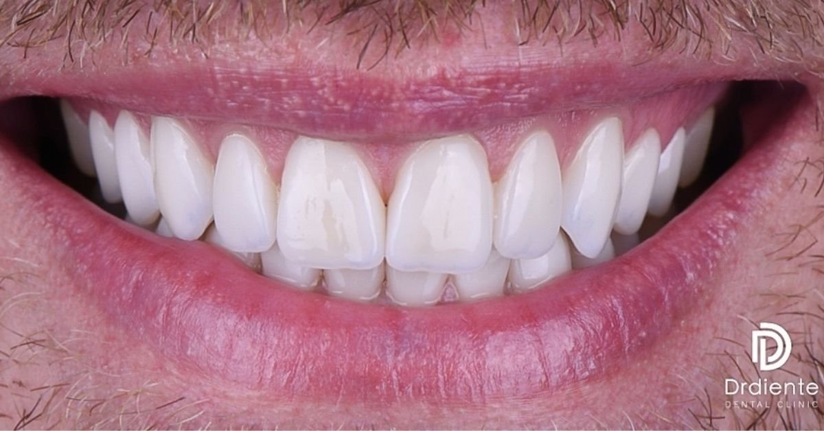 ¿Las carillas pueden cambiar de color con los años?