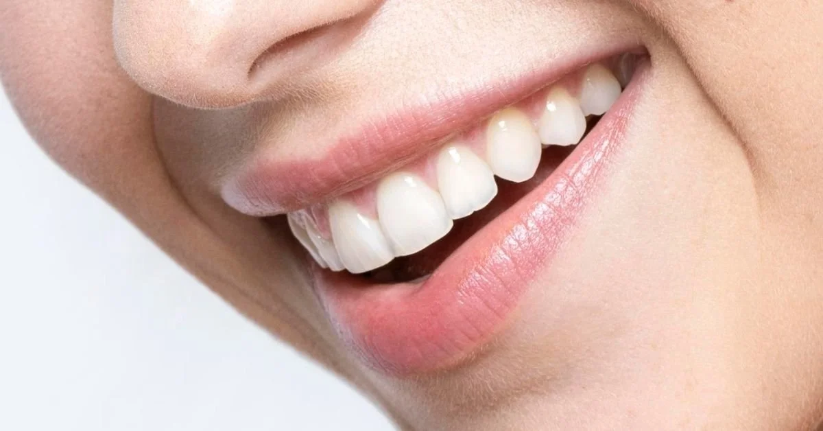 ¿Qué es la fluorescencia dental y por qué importa en carillas?