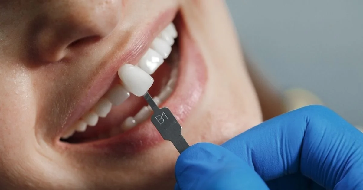 ¿Qué pasa si tengo dientes muy pequeños?