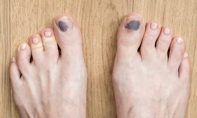 The Truth About Black Toenails and Blisters: Toenails Are Overrated!