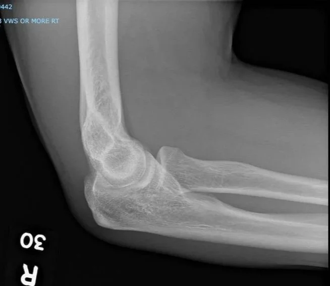 Jarred's elbow after an interesting weekend.