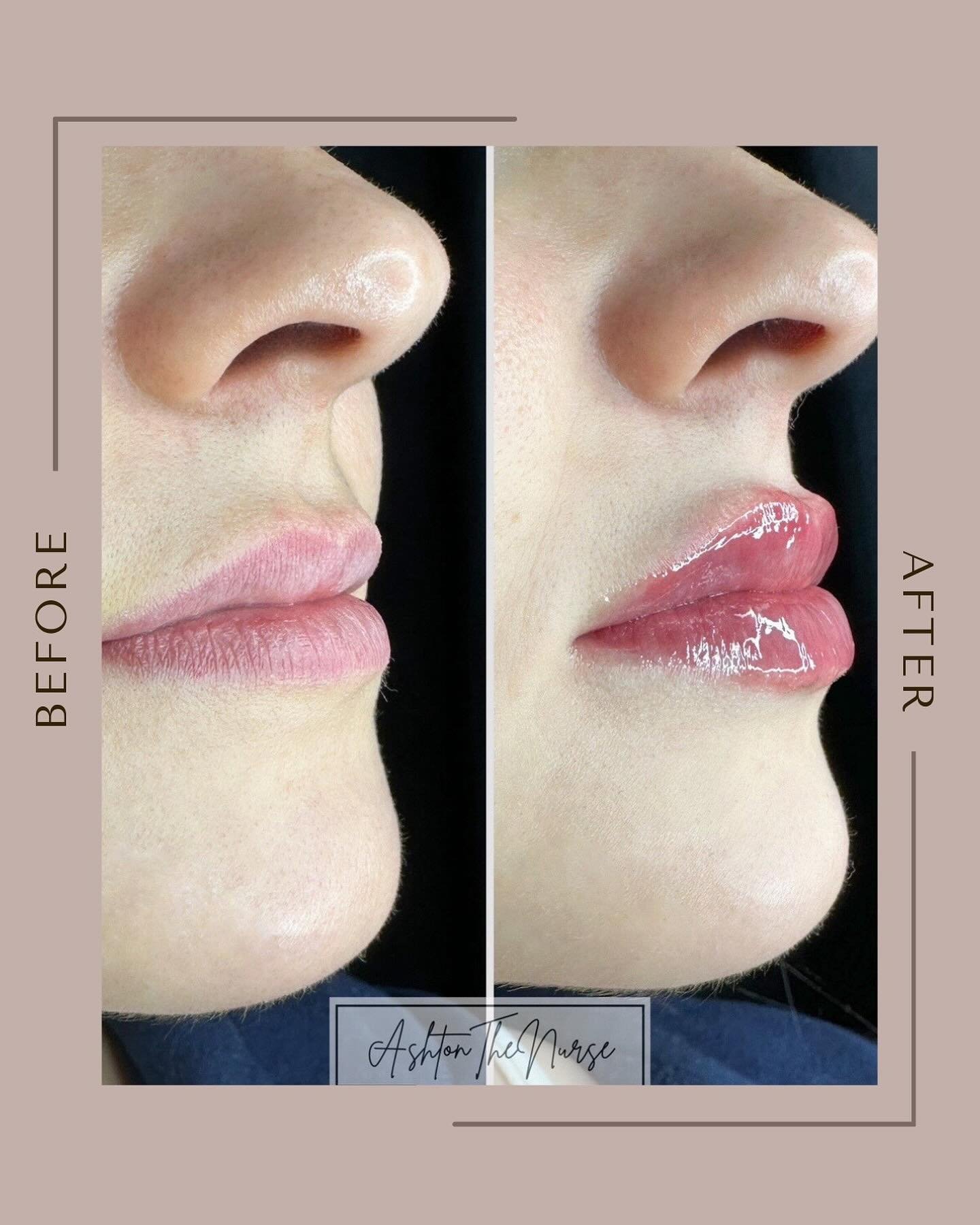 This before &amp; after has us in AWE 😍 

We are obsessed.. @ashtonthenurse will leave your lips looking natural and puckered after every session. 

👄 Call 616.918.6490 to schedule your appointment!