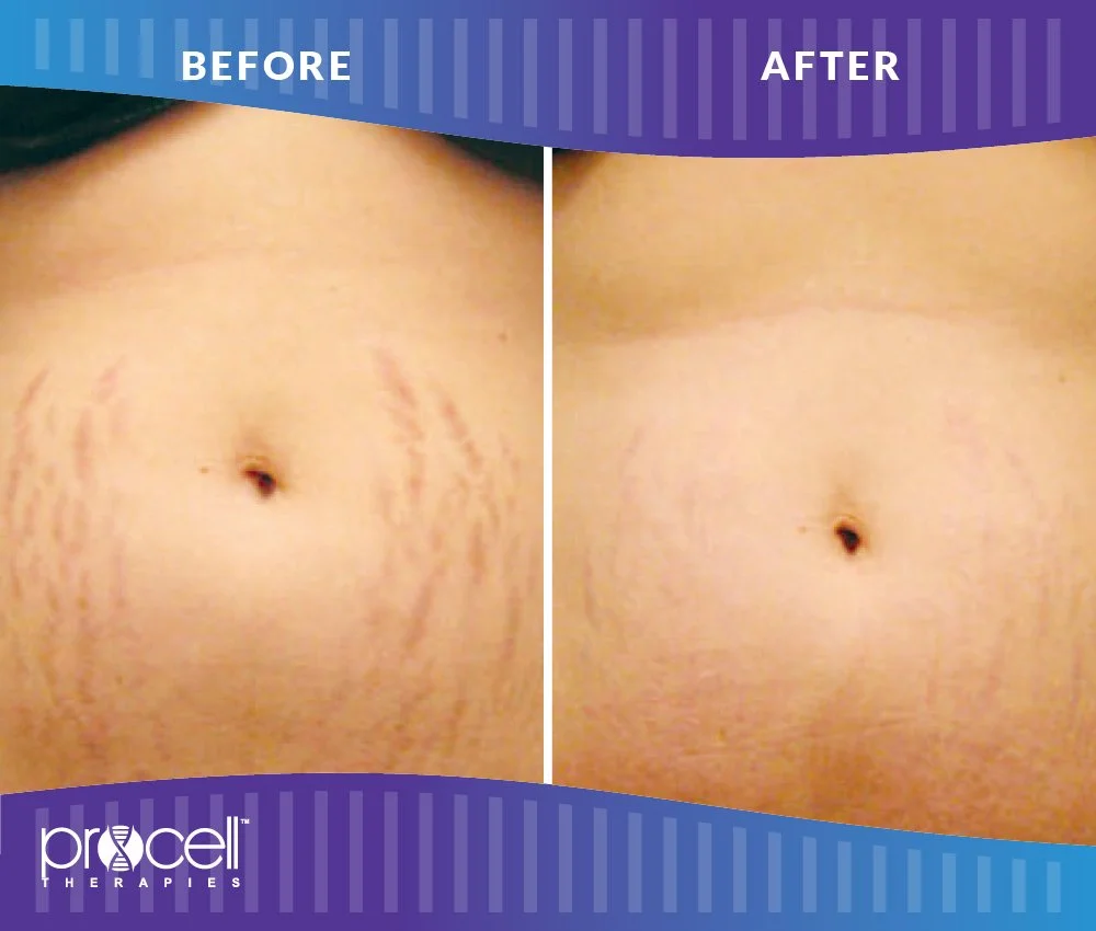 ProCellStretchMarks_B_A-001.JPG