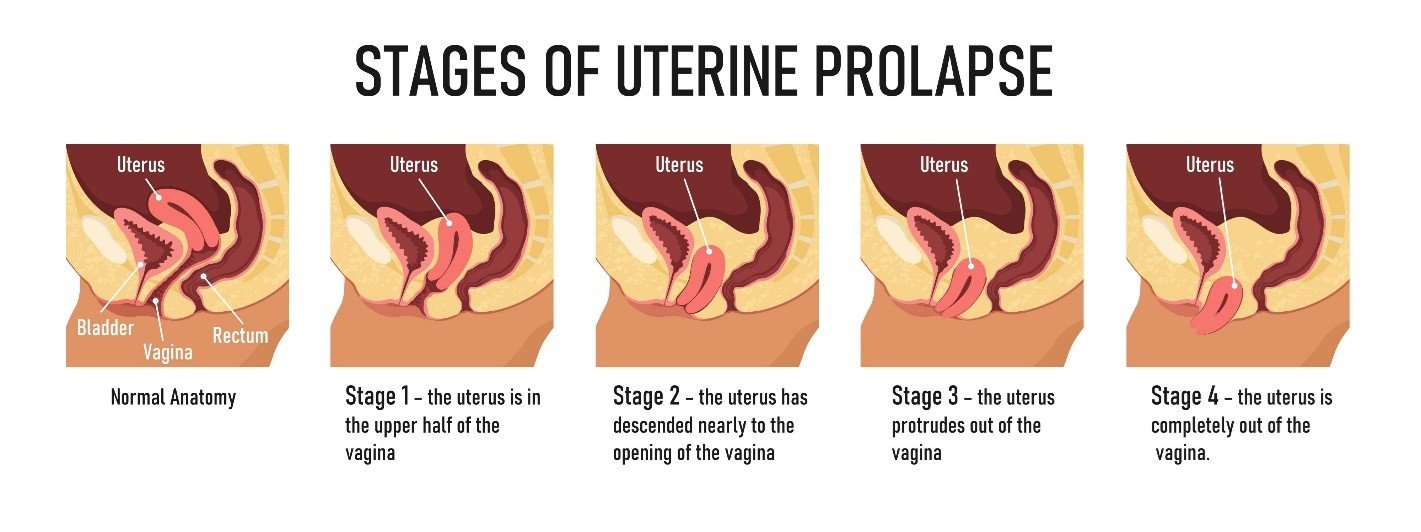 Attention: Post-Menopausal Women