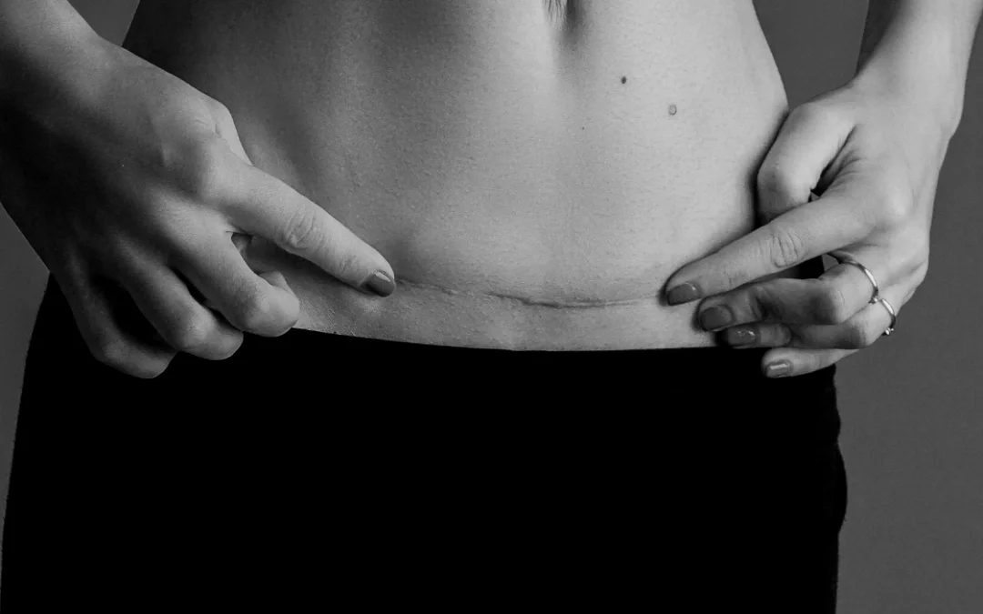 Woman showing her c-section scar that's healed