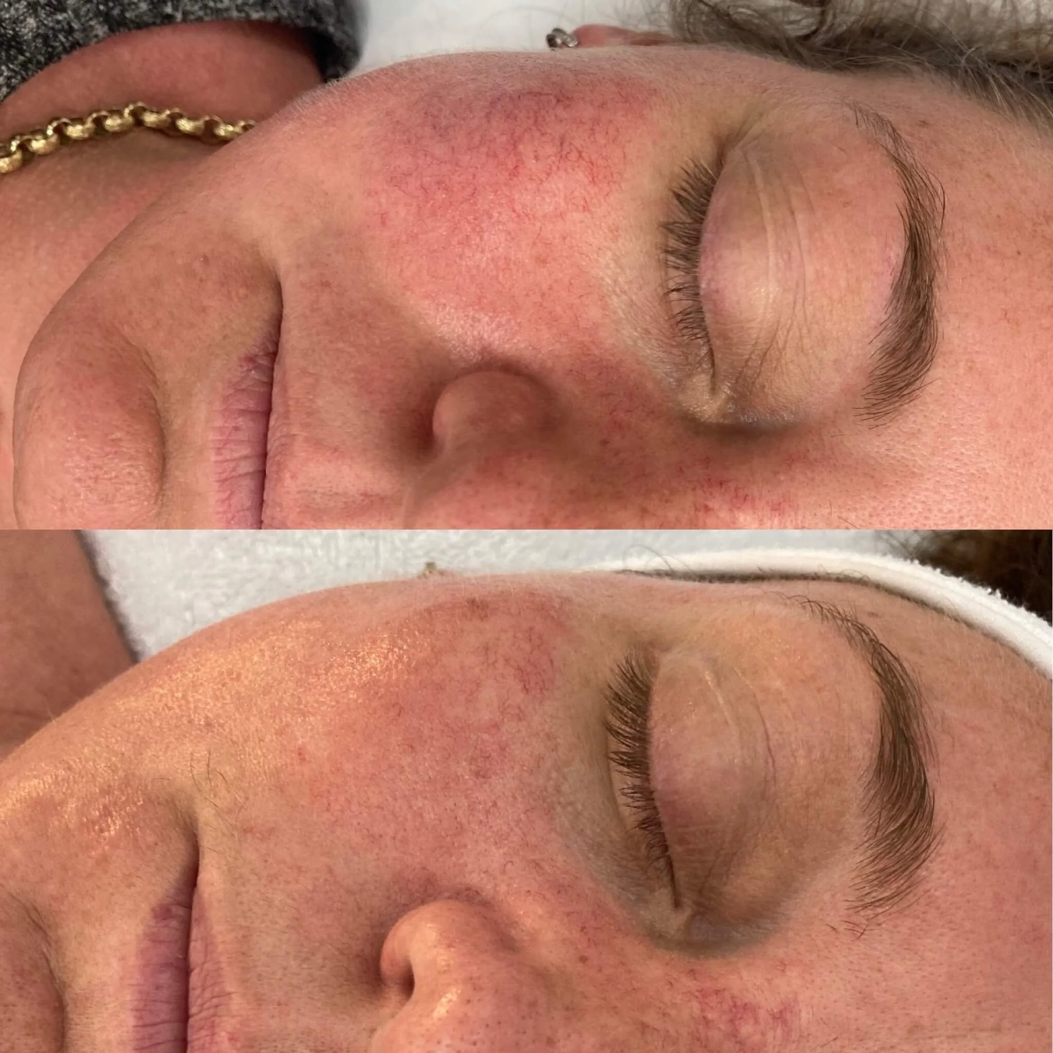 IPL before and after result for redness and rosacea concerns