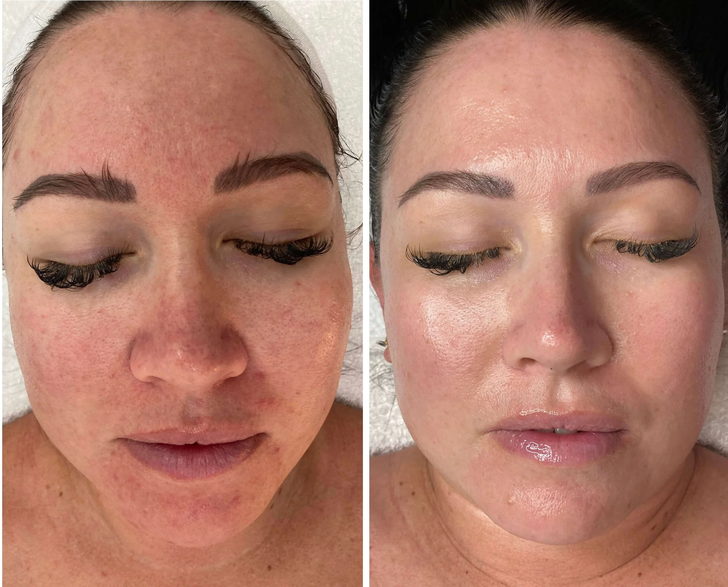 Facial and peel before and after result for redness and skin health