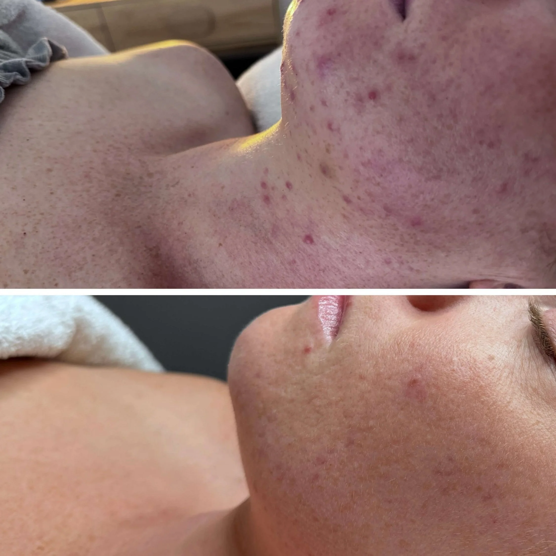 Facial and peel before and after result for acne concerns