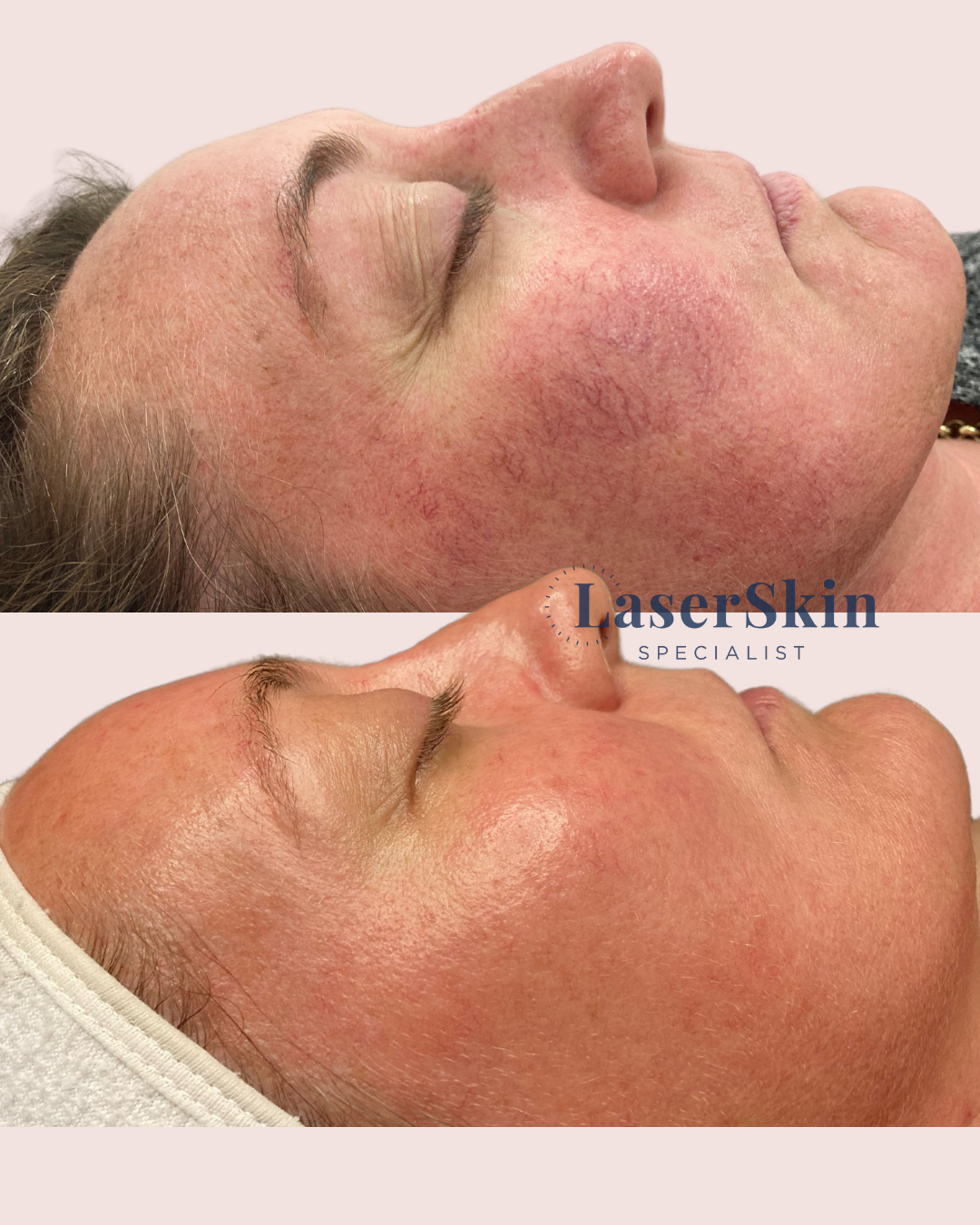 REDNESS & ROSACEA | Before & After 3x IPL Treatments