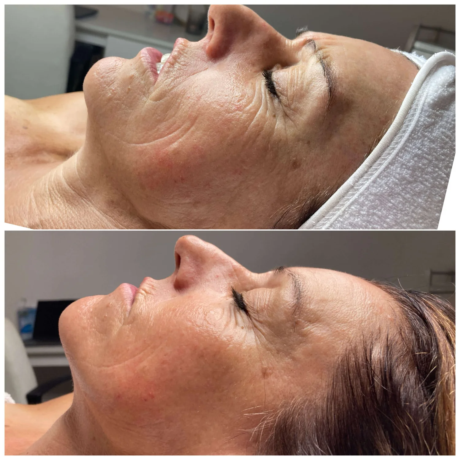 Laser treatment for skin near me