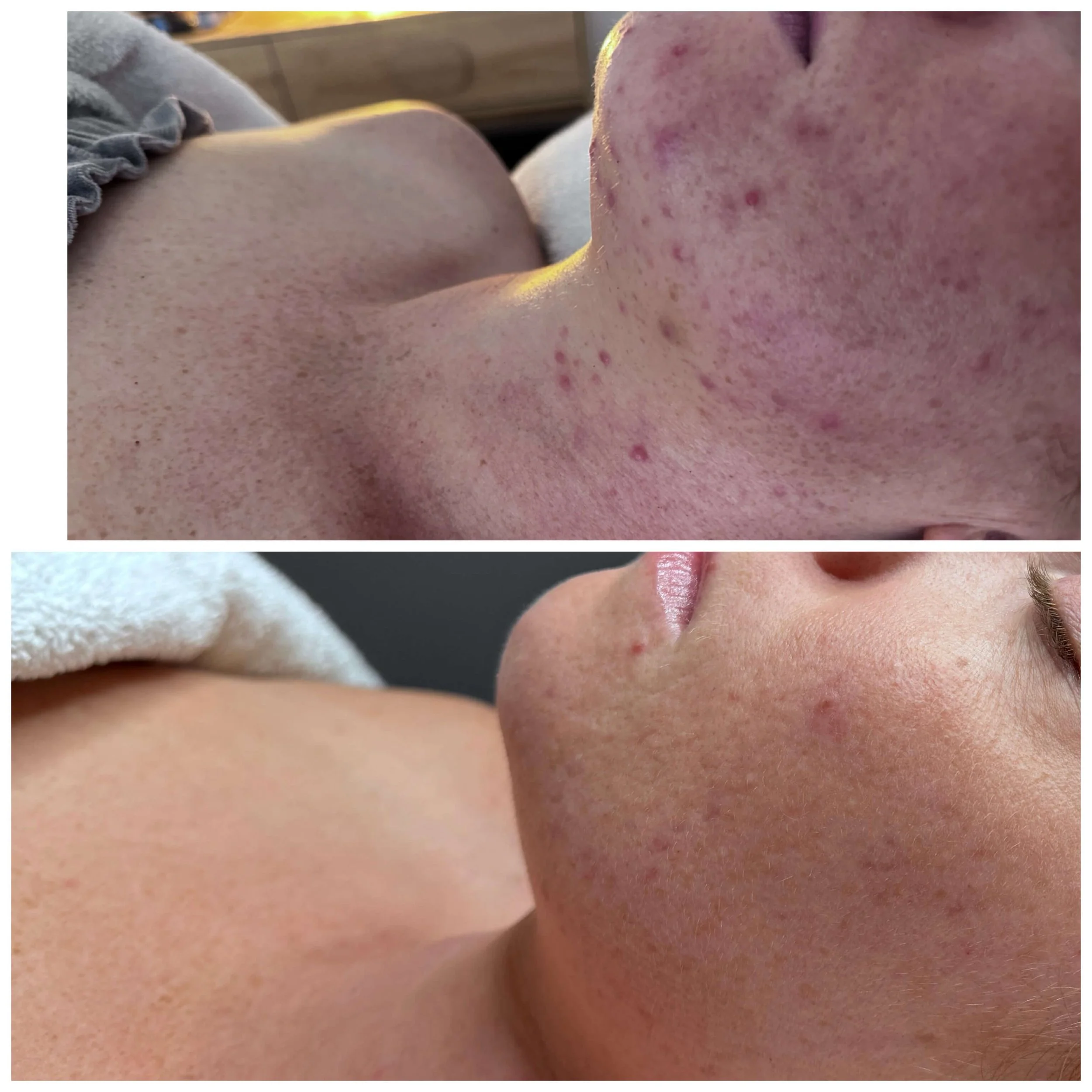 Laser Treatment for Skin Near Me Revitalize Your Skin Laser Treatment for Skin Near Me Revitalize Your Skin