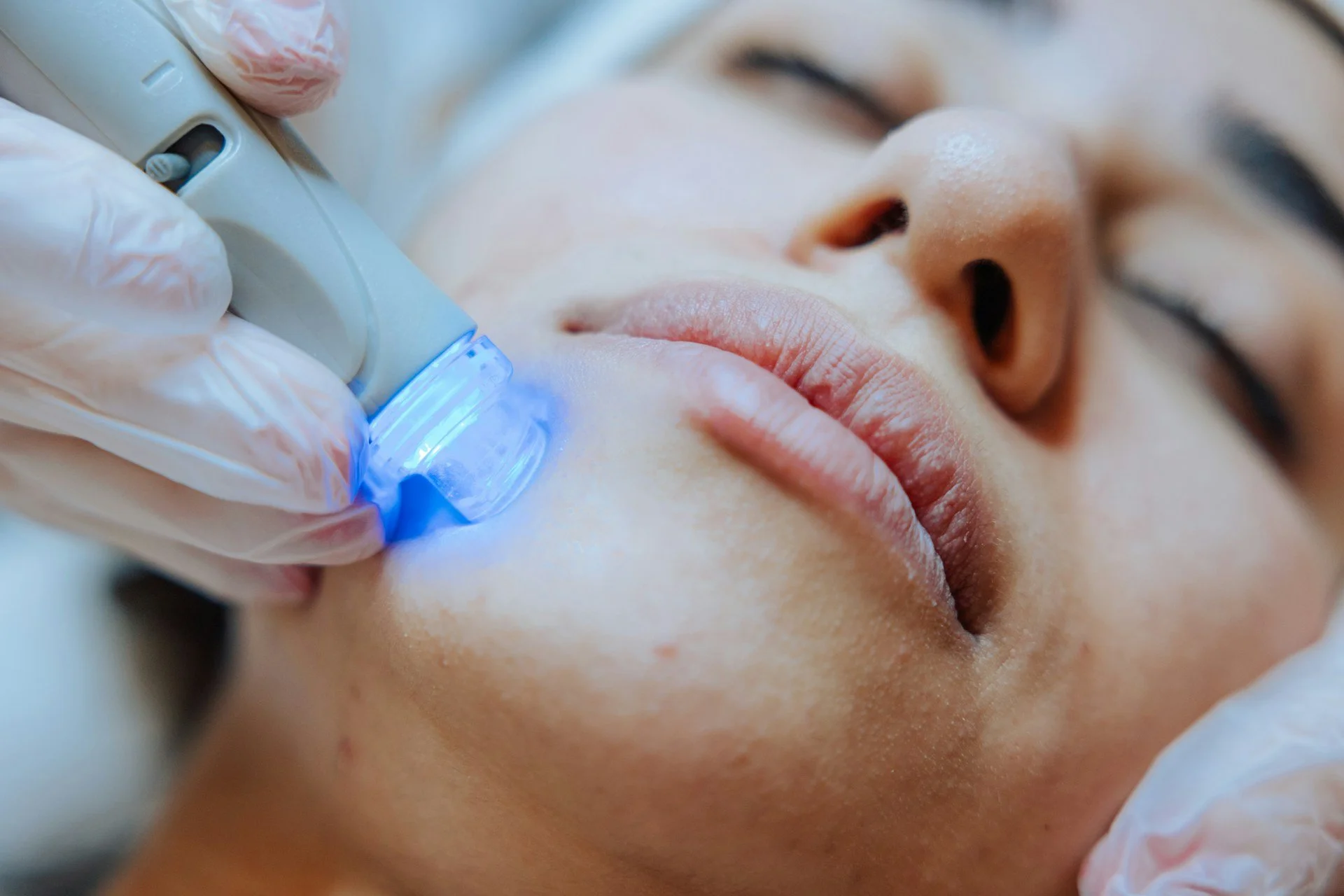 How Do Anti-Aging Laser Treatments Target Deep Wrinkles?