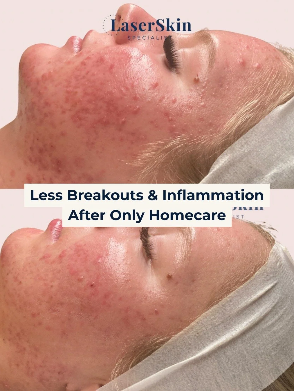 🤯 Less Breakouts &amp; Inflammation After Only Homecare! 

This is the power of a personalised, expert led approach. Our 20 year old client came to us with severe acne, inflammation, and a compromised skin barrier that was affecting her mental healt