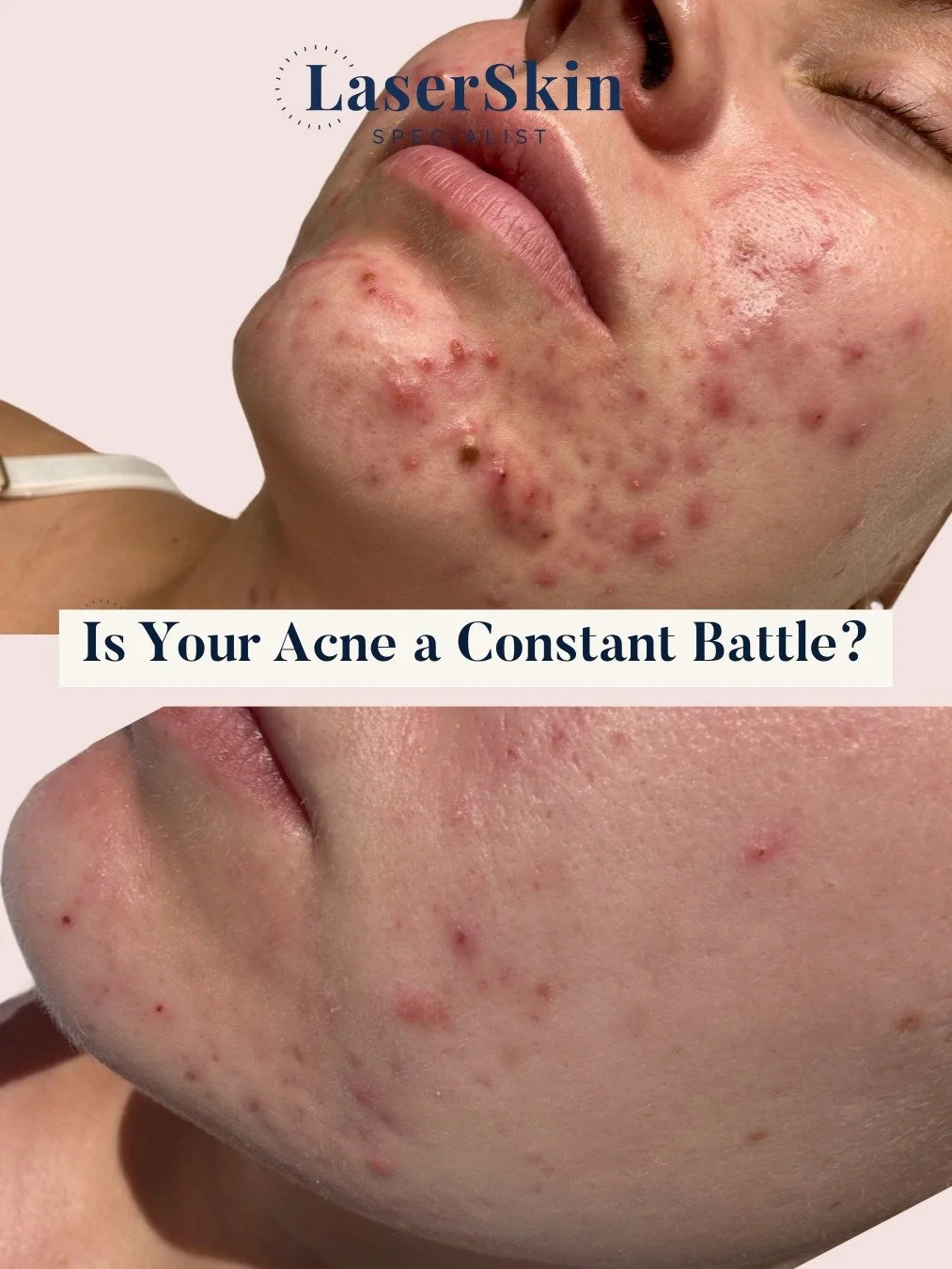 ✨ Is Your Acne a Constant Battle? ✨

For many clients, acne isn't just a skin condition, it's a relentless battle that impacts confidence, mood, and daily life. 

The endless cycle of breakouts, temporary fixes, and self treatment can be incredibly f