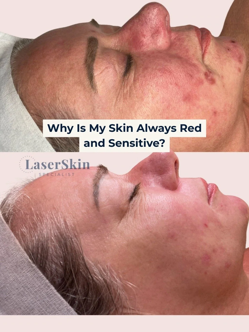 ✨ Why is Your Skin Always Red and Sensitive? Let's Uncover the Truth! 

Persistent redness and sensitivity aren't just cosmetic concerns; they often signal a deeper issue: a compromised skin barrier. 

At LaserSkin Specialist, we delve into the contr