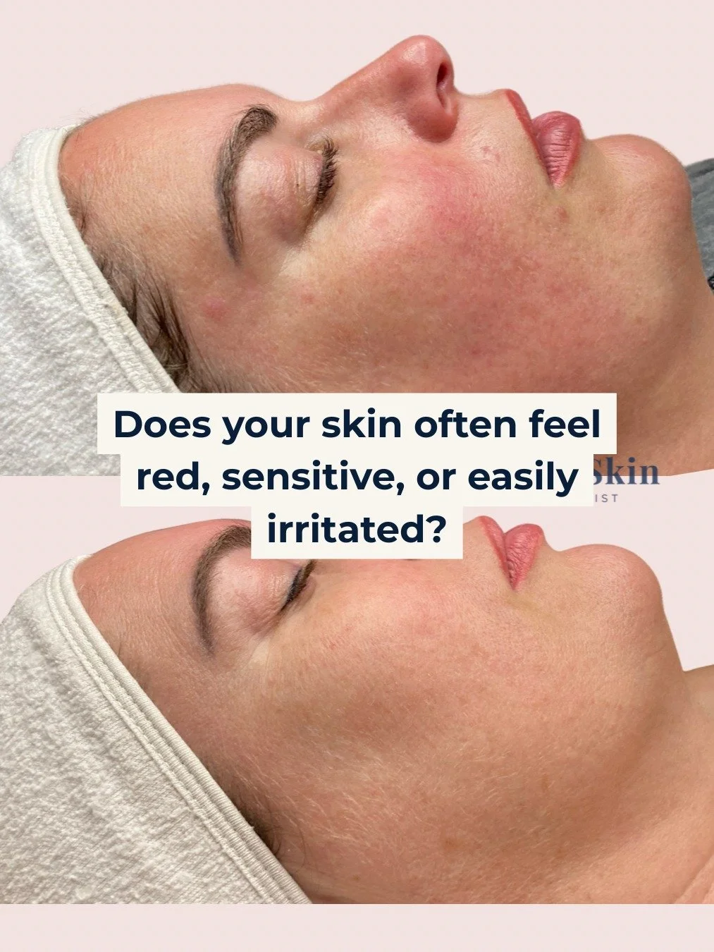 🔥 Does your skin often feel red, sensitive, or easily irritated? 

You're not alone. 

Many factors can contribute to these concerns, from a compromised skin barrier to environmental stressors and underlying inflammation. 🌿

At LaserSkin Specialist