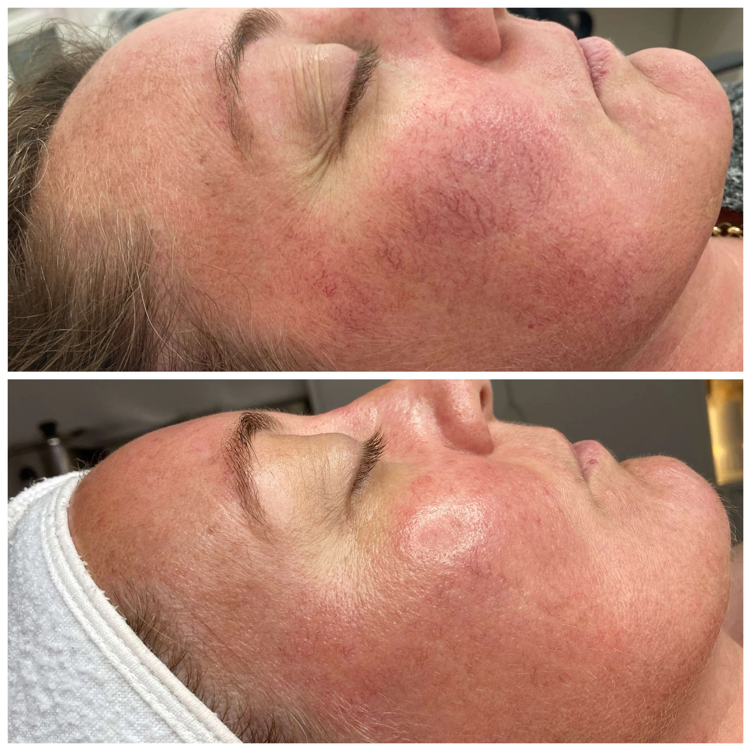BBL skin rejuvenation before and after result for redness and skin quality