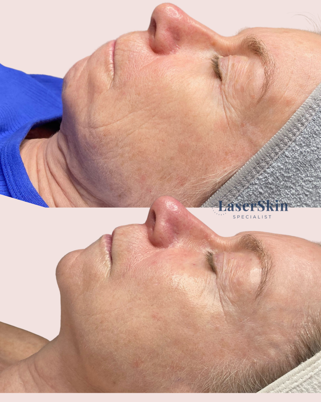 AGEING | Before & After 3 X Viva Nano Fractional & 6 RF Treatments