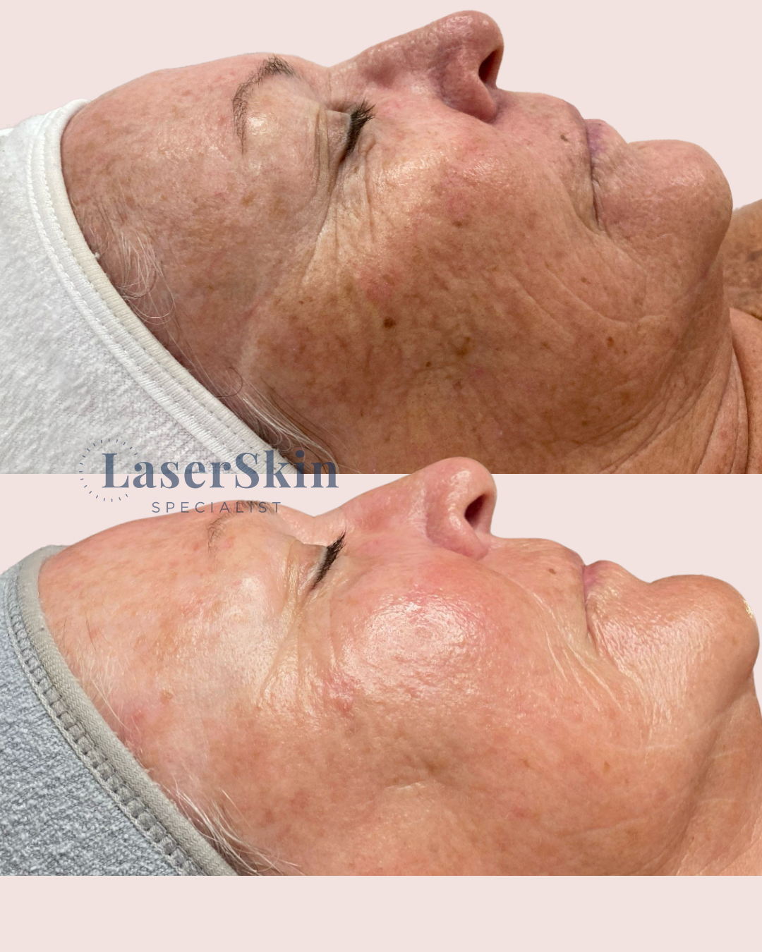 AGEING & PIGMENTATION | Before & After 3x BBL Rejuvenation Treatments