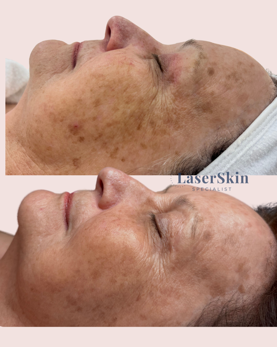PIGMENTATION | Before & After 6 X Facial Peel Treatments