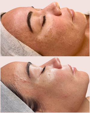 Advanced peels and needling pigmentation result before and after