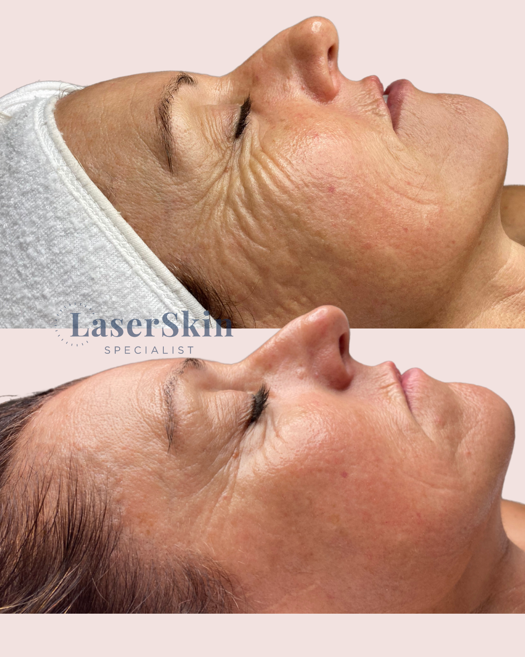 AGEING | Before & After 1x Viva Nano Fractional Treatment