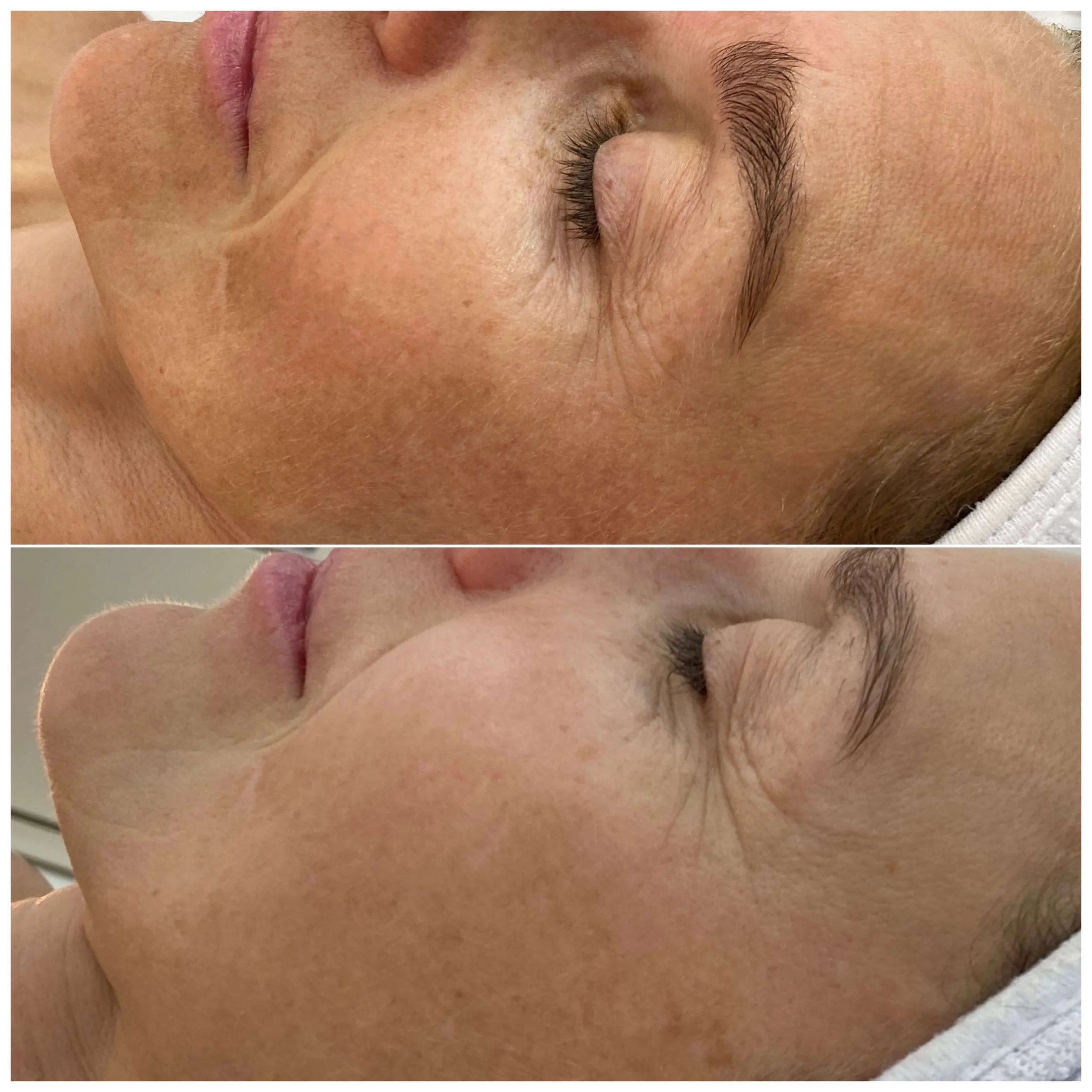 Pigmentation treatment before and after result